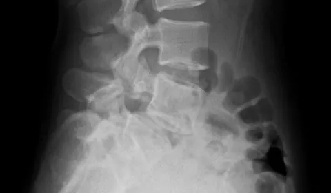 【案例】椎弓骨折