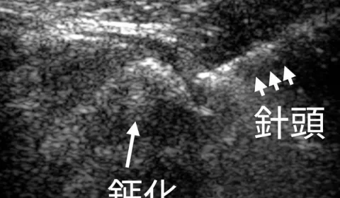 img_【治療】「戳爆」鈣化性肌腱炎