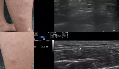 【趣聞】肌肉也會疝氣？