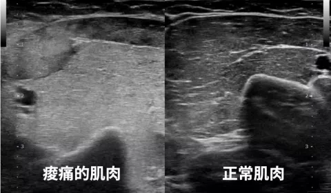 【案例】手肘伸不直的女子