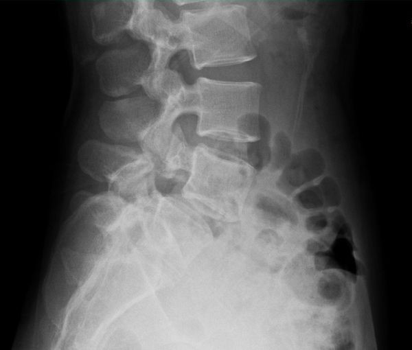 img-【案例】椎弓骨折