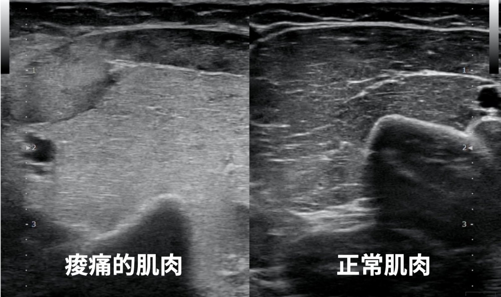 img-【案例】手肘伸不直的女子